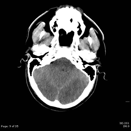 File:Brain death after motor vehicle collision (Radiopaedia 88470-105114 Axial non-contrast 9).jpg