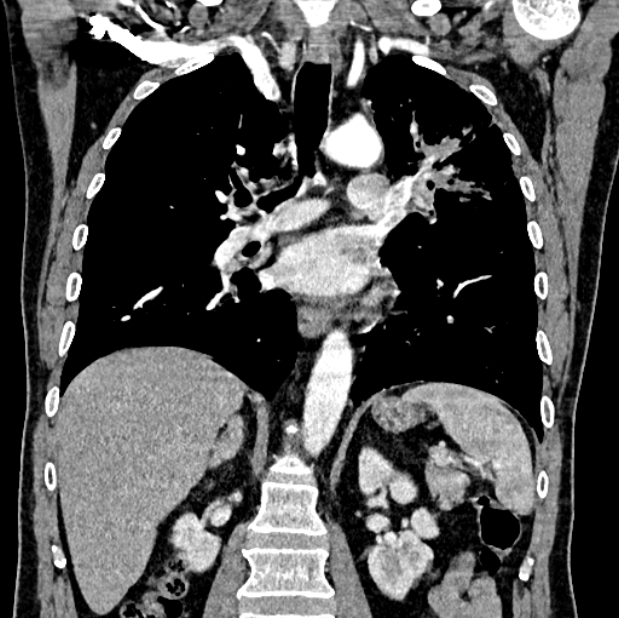 Brain metastases - lung cancer primary (Radiopaedia 75060-86116 C+ arterial phase 37).jpg