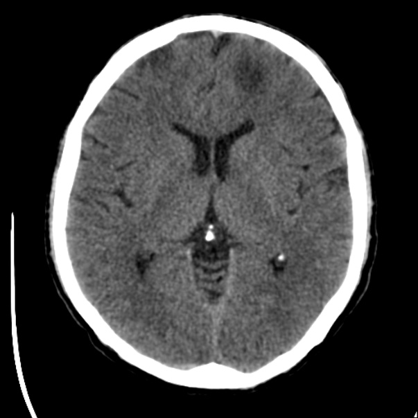Brain metastases from lung cancer (Radiopaedia 24480-24781 Axial non-contrast 24).jpg