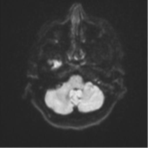 Brain metastasis (sarcoma) (Radiopaedia 47576-52209 Axial DWI 34).png