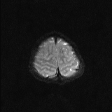 Brainstem glioma (Radiopaedia 67531-76922 Axial DWI 21).jpg