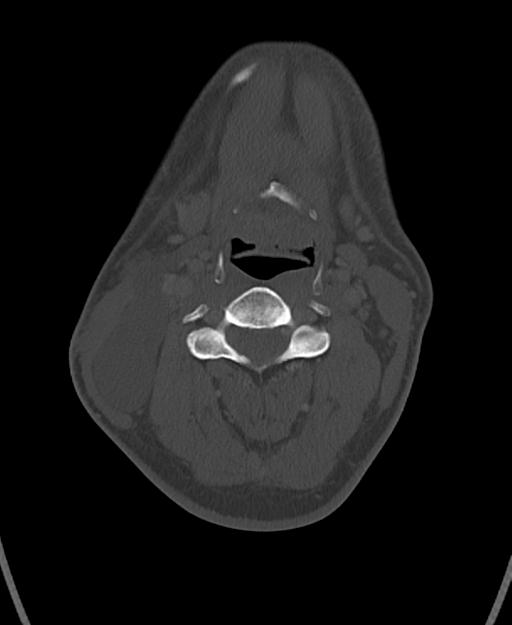 Branchial cleft cyst (Radiopaedia 31167-31875 Axial bone window 34).jpg
