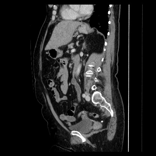 Breast cancer pseudocirrhosis with lobar invovlement (Radiopaedia 81080-94670 D 133).jpg