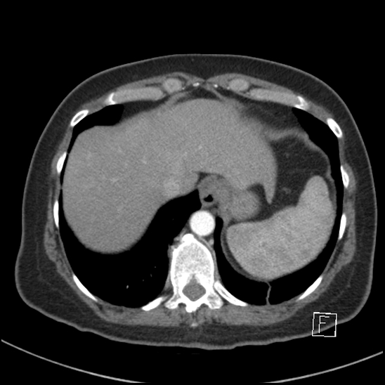 Breast metastases from renal cell cancer (Radiopaedia 79220-92225 A 77).jpg