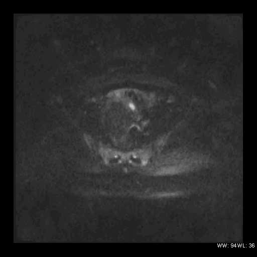 File:Broad ligament fibroid (Radiopaedia 49135-54241 Axial DWI 16).jpg