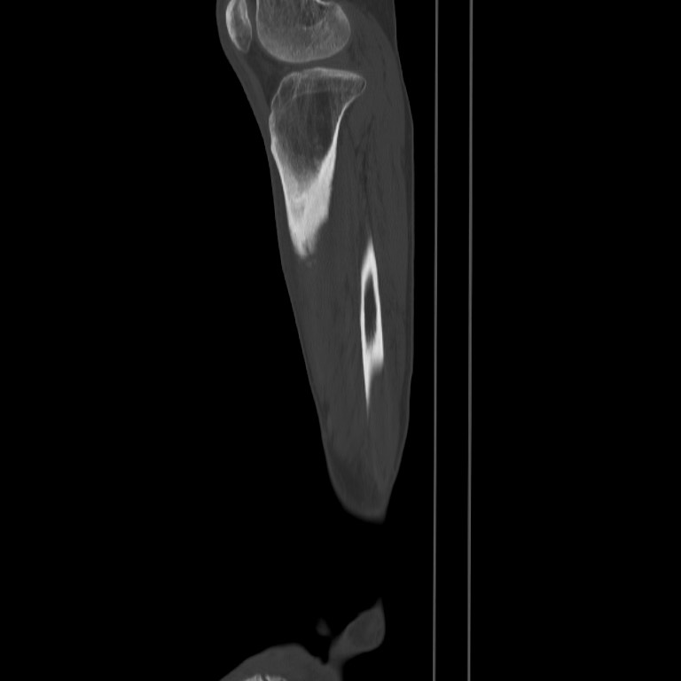 Brodie abscess - tibia (Radiopaedia 66028-75204 Sagittal bone window 59).jpg
