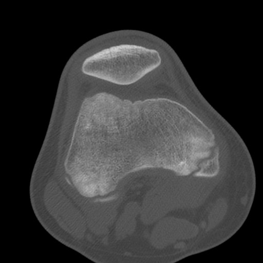 Brodie abscess of the tibia (Radiopaedia 58984-66250 Axial bone window 31).jpg