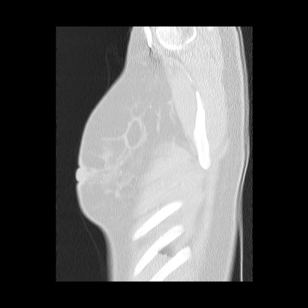 Bronchial atresia (Radiopaedia 22965-22992 Sagittal lung window 3).jpg