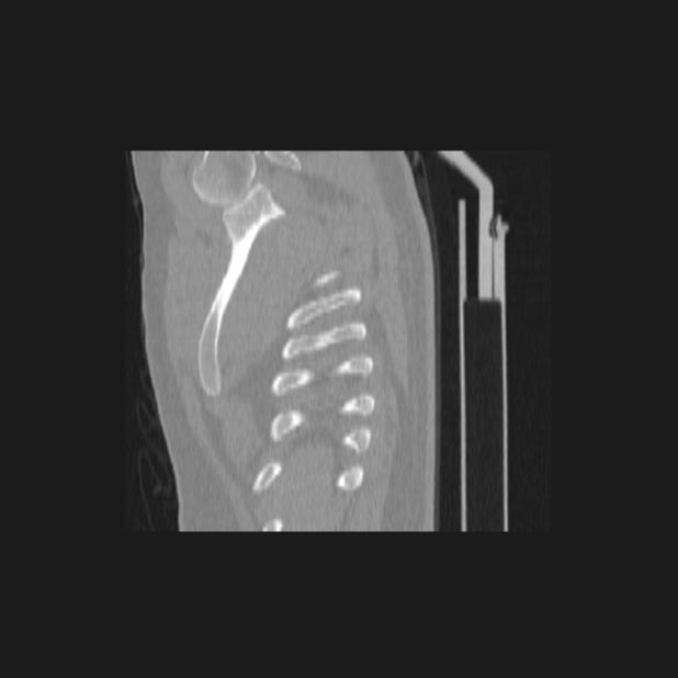 Bronchial atresia (Radiopaedia 60685-68439 Sagittal lung window 1).jpg