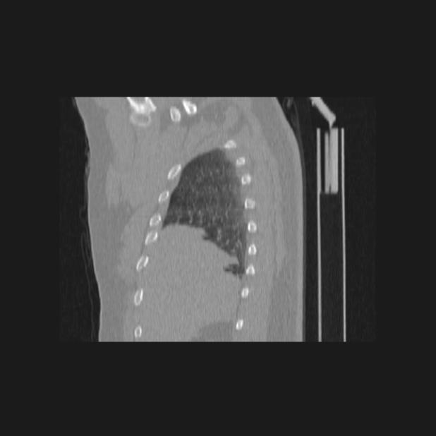 Bronchial atresia (Radiopaedia 60685-68439 Sagittal lung window 11).jpg