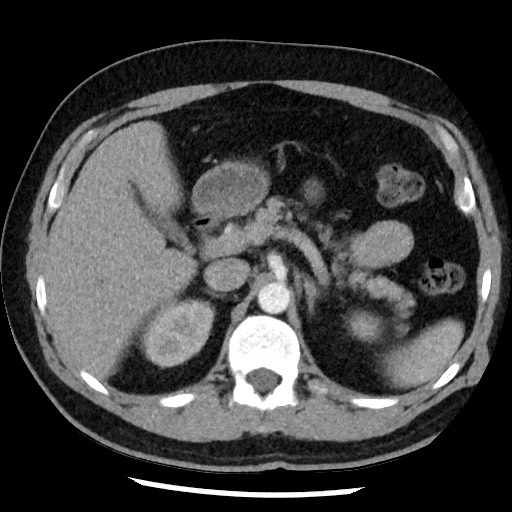 File:Bronchial carcinoid tumor (Radiopaedia 67377-76764 A 65).jpg