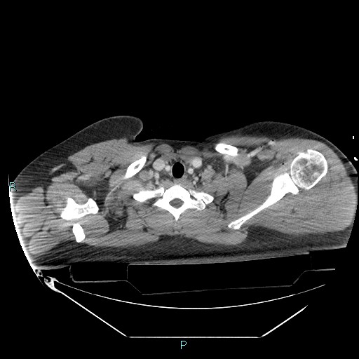 Bronchial carcinoid tumor (Radiopaedia 78272-90870 C 15).jpg