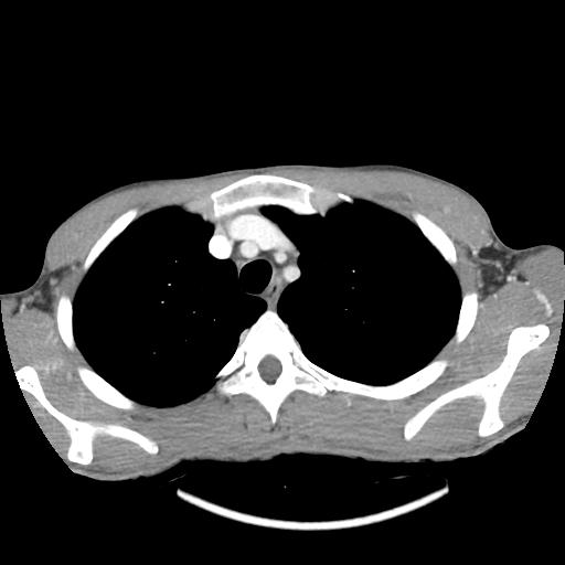 File:Bronchial carcinoid tumor causing right lower lobe collapse (Radiopaedia 83495-98594 A 8).jpg
