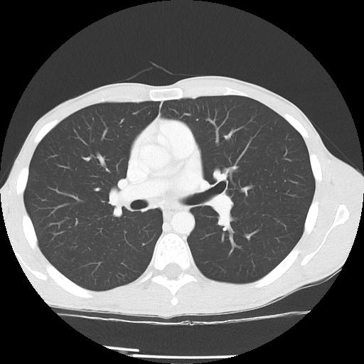 Bronchial carcinoid tumor causing right lower lobe collapse (Radiopaedia 83495-98594 Axial lung window 23).jpg
