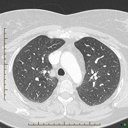 Bronchial diverticula (Radiopaedia 79512-92676 Axial lung window 53).jpg