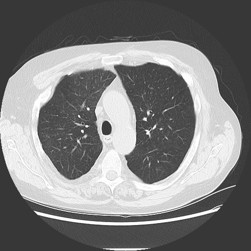 File:Bronchial stenosis - lung transplant (Radiopaedia 73133-83848 Axial lung window 22).jpg