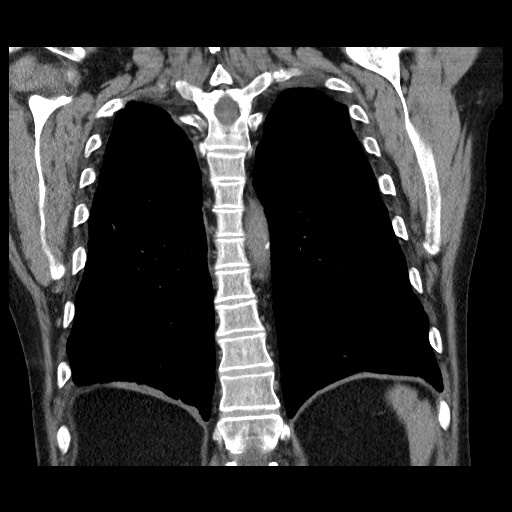 Bronchial stenosis - lung transplant (Radiopaedia 73133-83848 Coronal non-contrast 48).jpg
