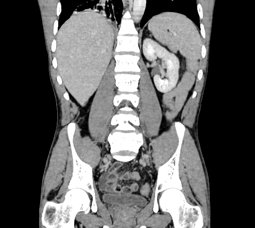 Bronchiectasis in Crohn disease (Radiopaedia 60311-67977 C 53).jpg