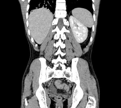 File:Bronchiectasis in Crohn disease (Radiopaedia 60311-67977 C 64).jpg