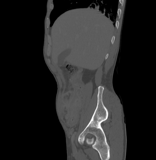 File:Bronchiectasis in Crohn disease (Radiopaedia 60311-67977 Sagittal bone window 38).jpg