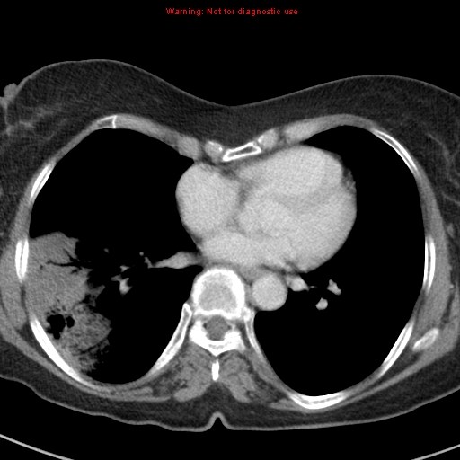 File:Bronchoalveolar carcinoma (BAC) (Radiopaedia 13436-13392 B 33).jpg