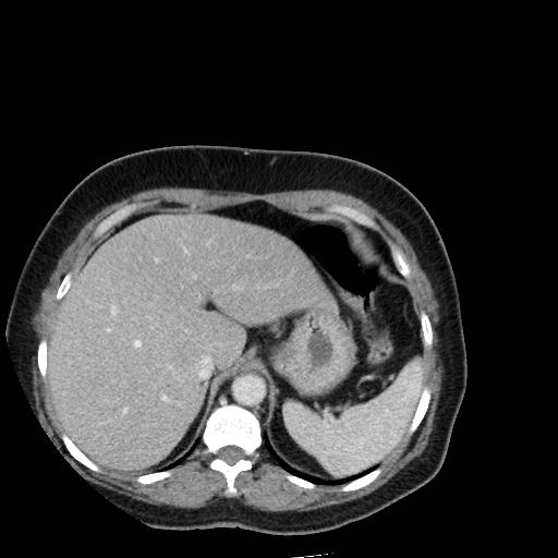 Bronchogenic carcinoma (Radiopaedia 73497-84262 A 56).jpg