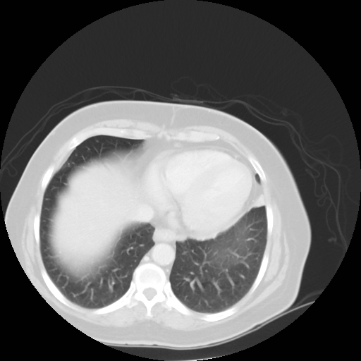 Bronchogenic carcinoma (Radiopaedia 73497-84262 Axial lung window 48).jpg