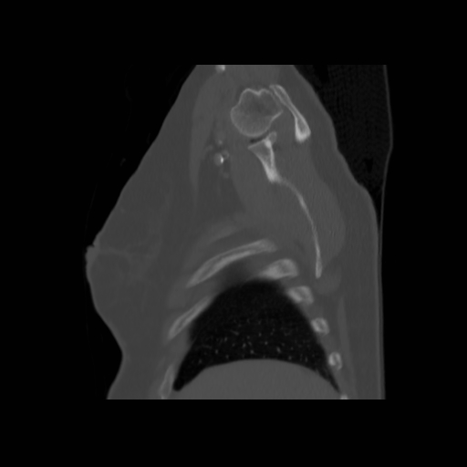 Bronchogenic carcinoma (Radiopaedia 73497-84262 Sagittal bone window 29).jpg