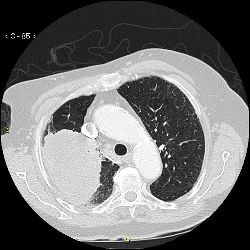 Bronchogenic carcinoma as an incidental finding (Radiopaedia 16453-16130 Axial lung window 85).jpg