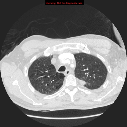 File:Bronchogenic carcinoma brain metastasis (Radiopaedia 9286-105832 Axial lung window 26).jpg