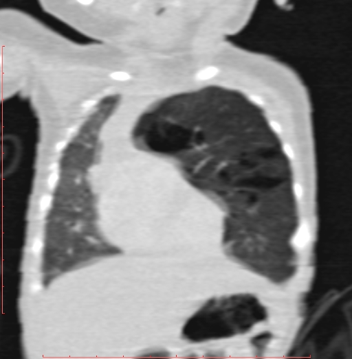 Bronchogenic cyst (Radiopaedia 78599-91409 Coronal lung window 70).jpg
