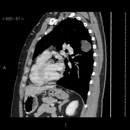 Bronchogenic cyst - posterior mediastinal (Radiopaedia 43885-47364 B 54).jpg