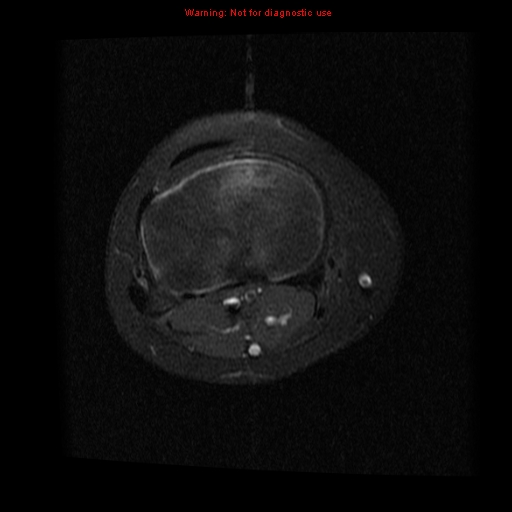 File:Brown tumor (Radiopaedia 12318-12597 Axial T1 C+ fat sat 12).jpg
