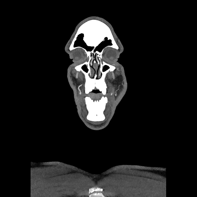 Buccal fat pad arteriovenous malformation (Radiopaedia 70936-81144 B 6).jpg