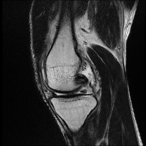 File:Bucket handle tear - medial meniscus (Radiopaedia 69245-79026 Sagittal T2 13).jpg