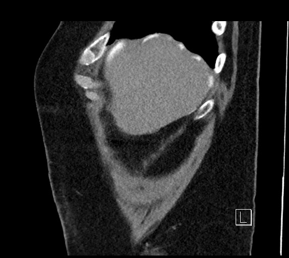 Buried bumper syndrome - gastrostomy tube (Radiopaedia 63843-72577 Sagittal Inject 108).jpg