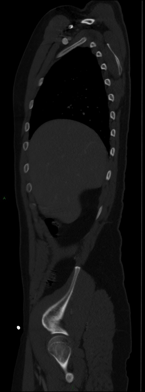 Burst fracture (Radiopaedia 83168-97542 Sagittal bone window 37).jpg