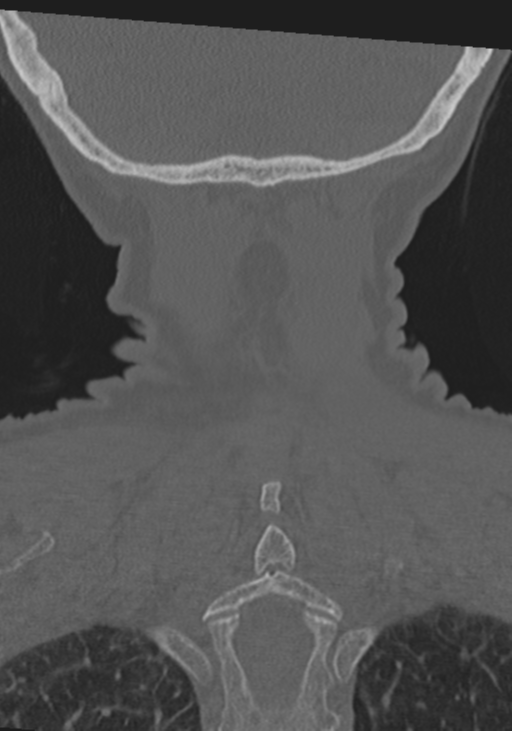 C2 fracture with vertebral artery dissection (Radiopaedia 37378-39199 Coronal bone window 51).png