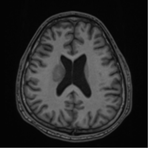 CNS vasculitis (Radiopaedia 55715-62263 Axial T1 51).png