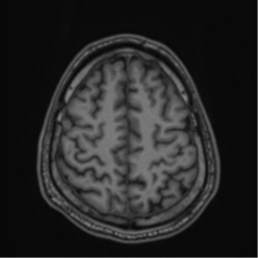 CNS vasculitis (Radiopaedia 55715-62263 Axial T1 76).png