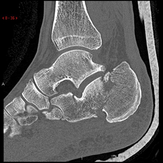 File:Calcaneal fracture and associated spinal injury (Radiopaedia 17896-17656 Sagittal bone window 2).jpg