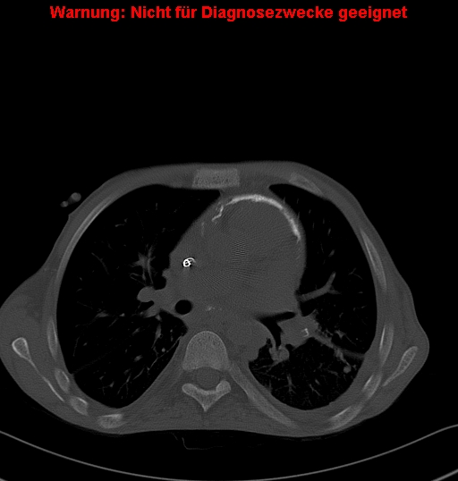 File:Calcific constrictive pericarditis (Radiopaedia 24701-24967 Axial bone window 8).jpg