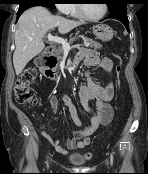 Calcified adrenal glands and Spigelian hernia (Radiopaedia 49741-54988 B 44).jpg