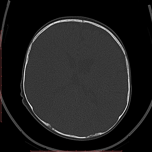 File:Calcified middle cerebral artery embolism (Radiopaedia 78949-91860 Axial bone window 40).jpg