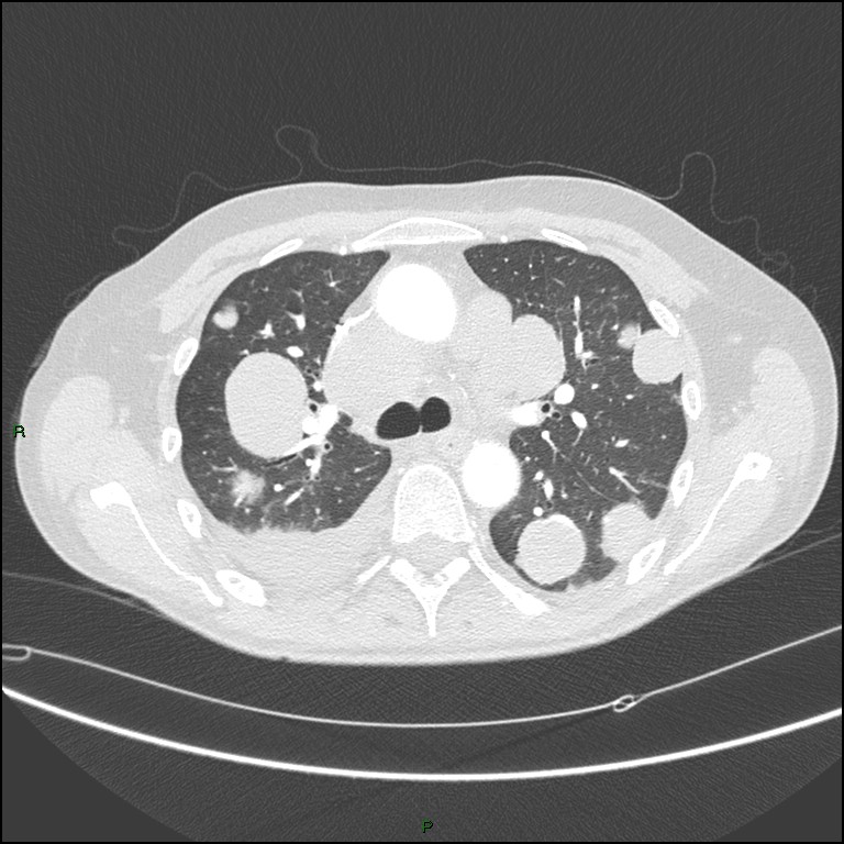 Cannonball metastases (Radiopaedia 82110-96150 Axial lung window 76).jpg