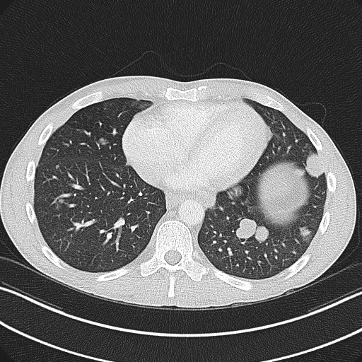 Cannonball metastases - testicular choriocarcinoma (Radiopaedia 84510-99891 Axial lung window 69).jpg
