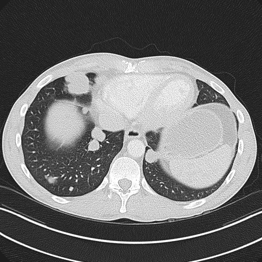 Cannonball metastases - testicular choriocarcinoma (Radiopaedia 84510-99891 Axial lung window 76).jpg