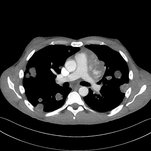 Cannonball metastases - testicular choriocarcinoma (Radiopaedia 84510-99891 B 56).jpg