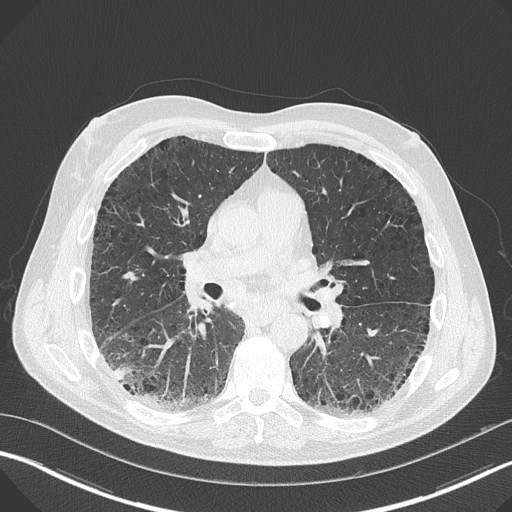 Caplan syndrome (Radiopaedia 56667-63530 Axial lung window 103).jpg