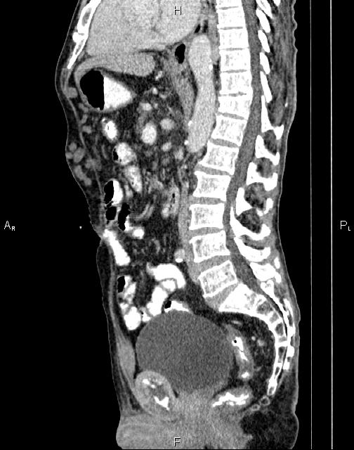 Caput medusae sign - portal hypertension (Radiopaedia 64007-72759 B 42).jpg